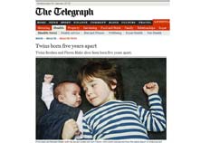 Pequena Floren, de apenas sete semanas, com o irmão gêmeo de cinco anos Reuben Blake - The Telegraph / Reprodução