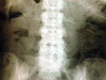 As imagens dos exames feitos mostram vrias agulhas espalhadas pelo corpo da mulher