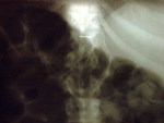 As imagens dos exames feitos mostram vrias agulhas espalhadas pelo corpo da mulher