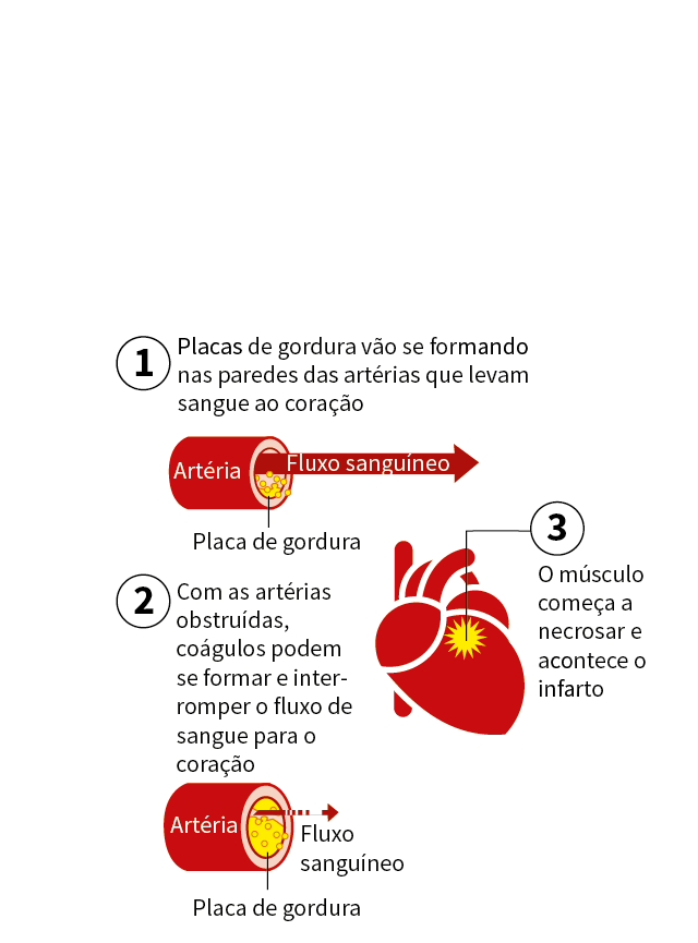 Quais são os principais sinais de infarto? • Summit Saúde Estadão